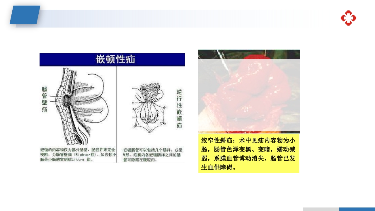 腹外疝病人的护理PPT课件6