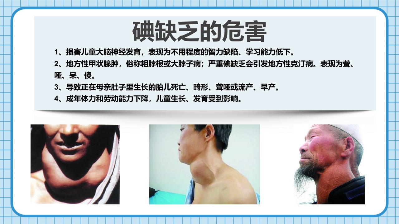 防治碘缺乏病日知识讲座PPT课件17