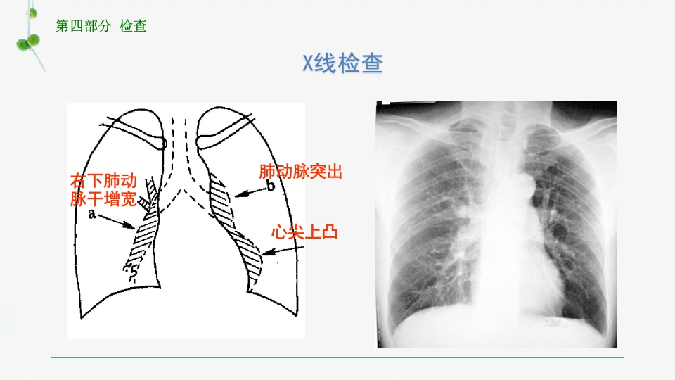 慢性肺源性心脏病患者的护理PPT课件18