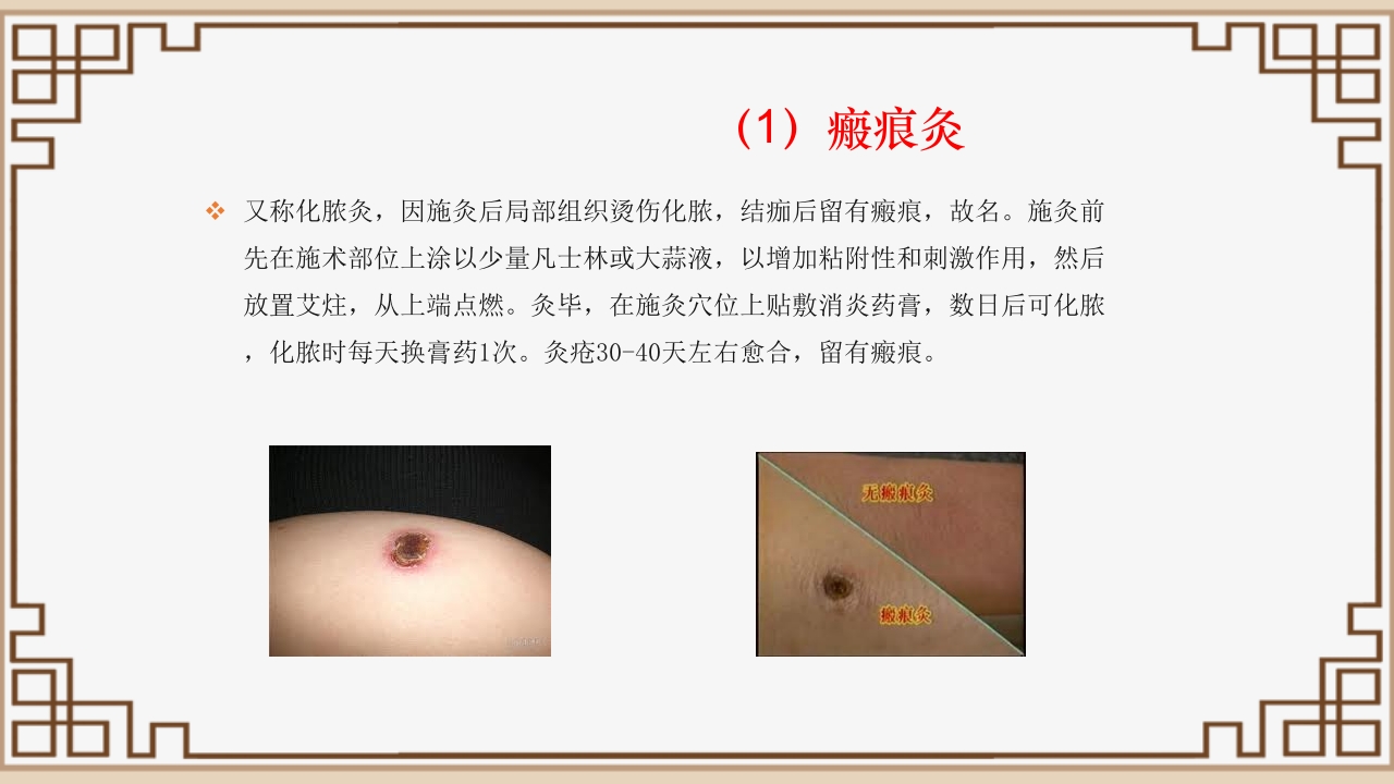 中医艾灸疗法PPT课件18