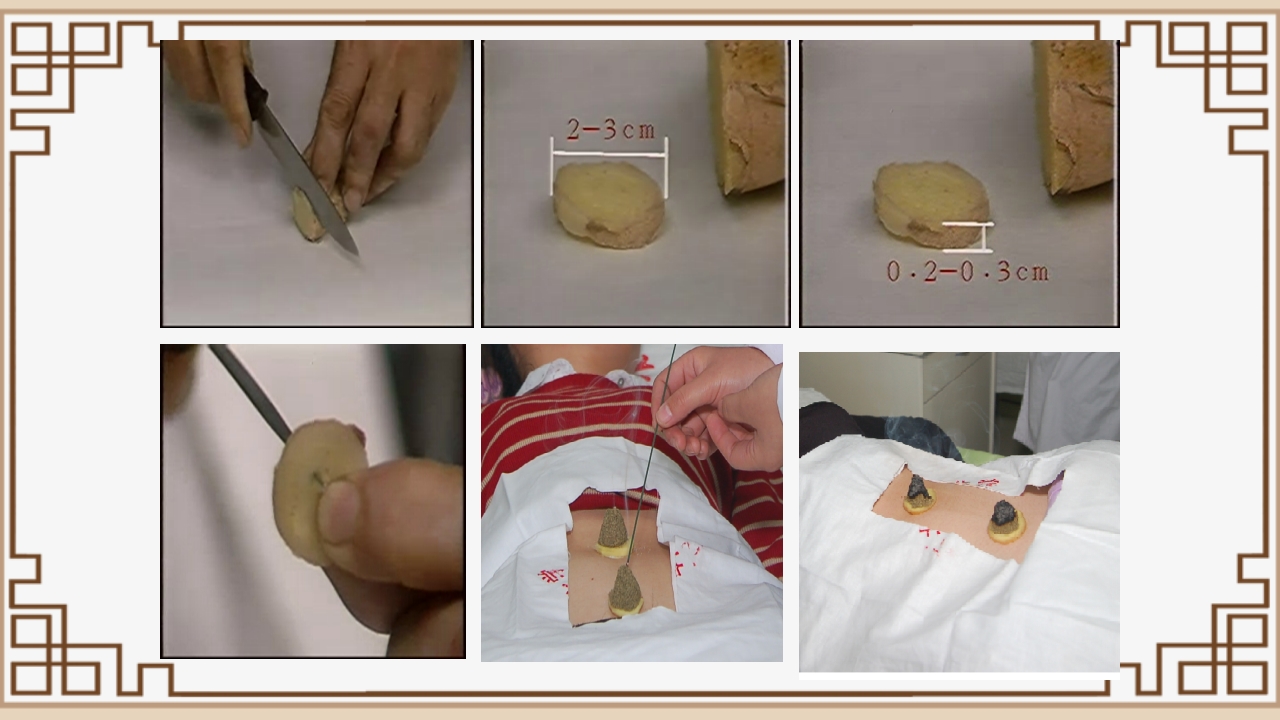 中医艾灸疗法PPT课件23