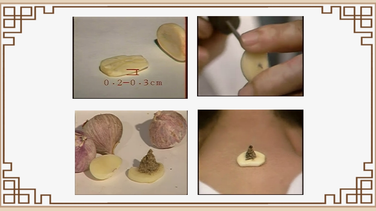 中医艾灸疗法PPT课件27