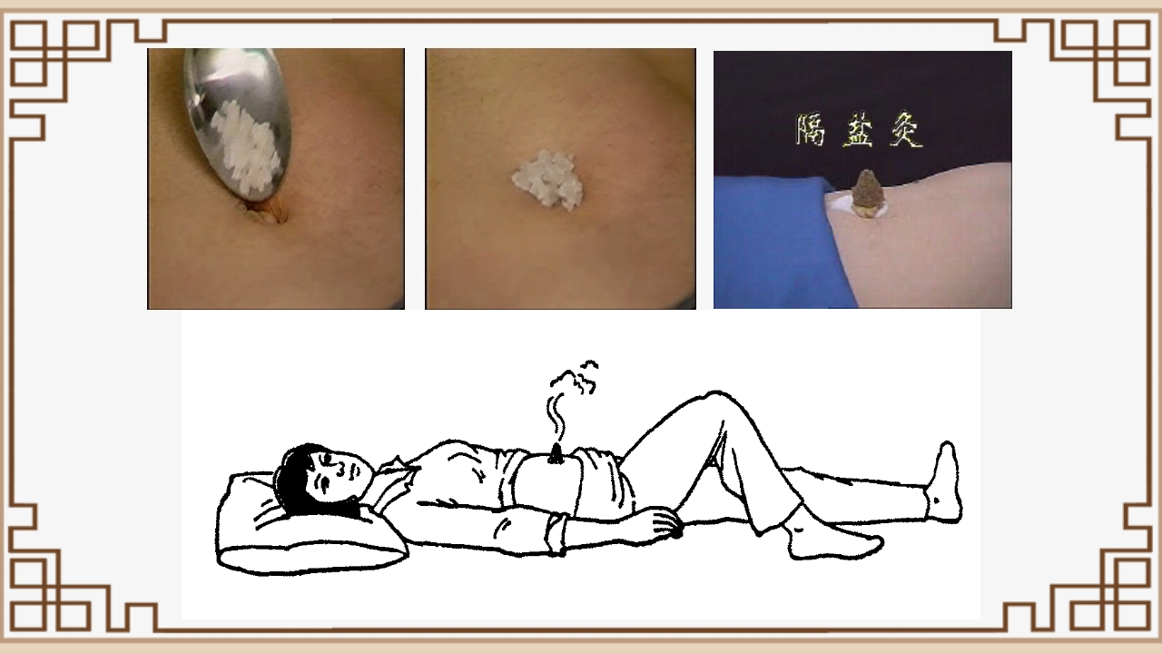 中医艾灸疗法PPT课件30