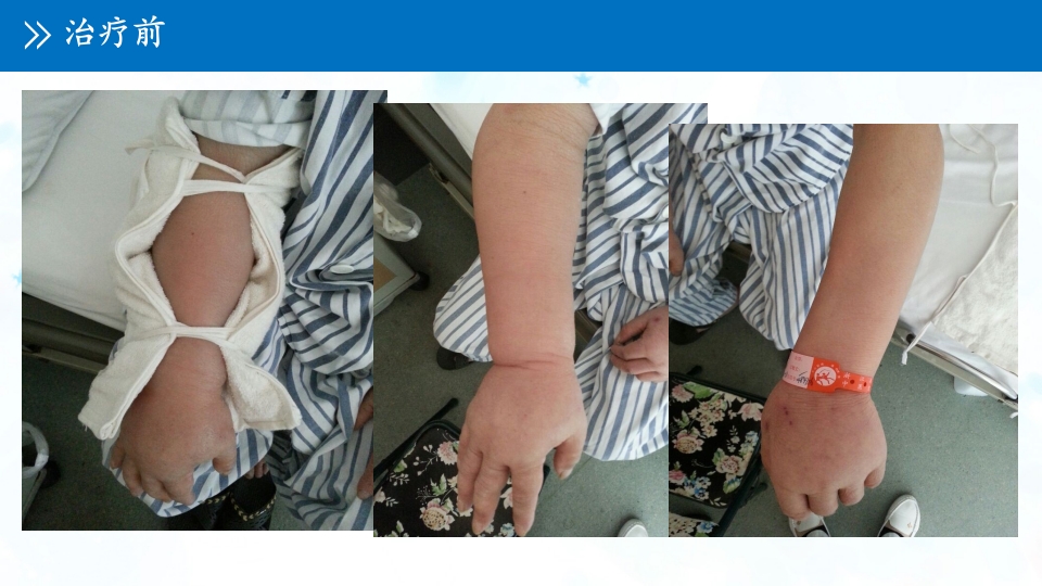 肺癌伴上腔静脉综合症ppt课件23