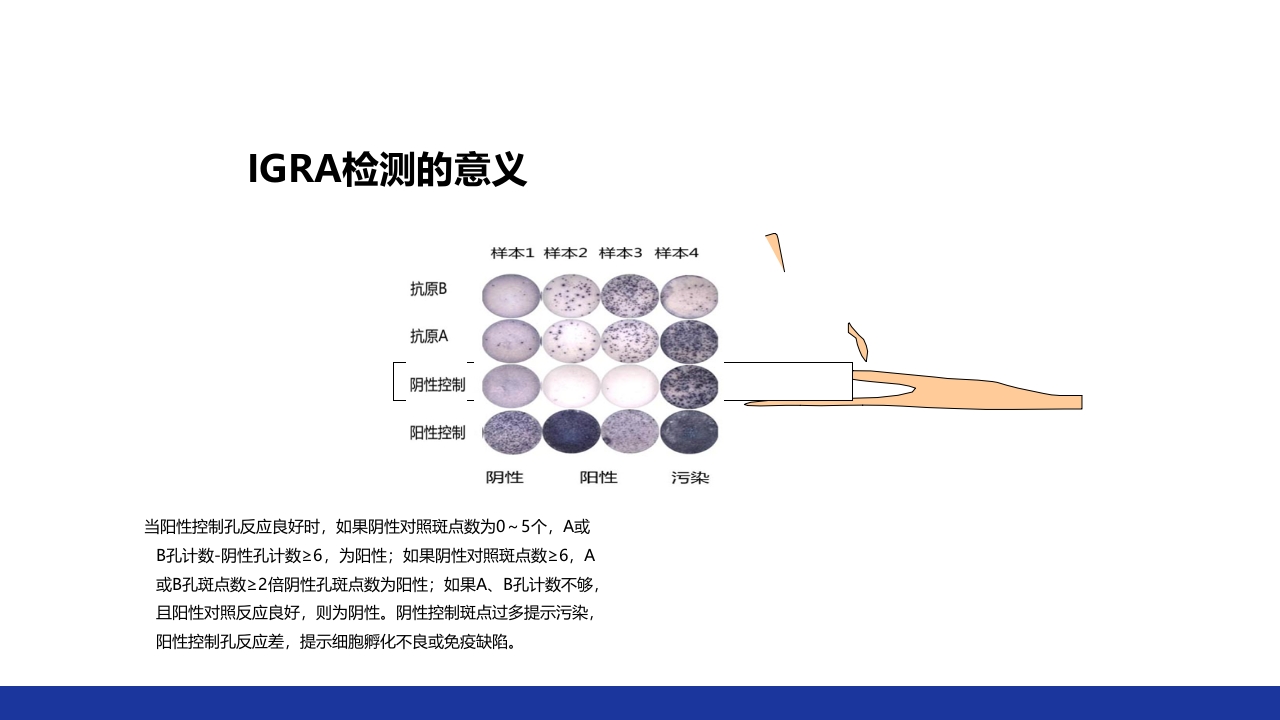 非结核分枝杆菌感染PPT课件21