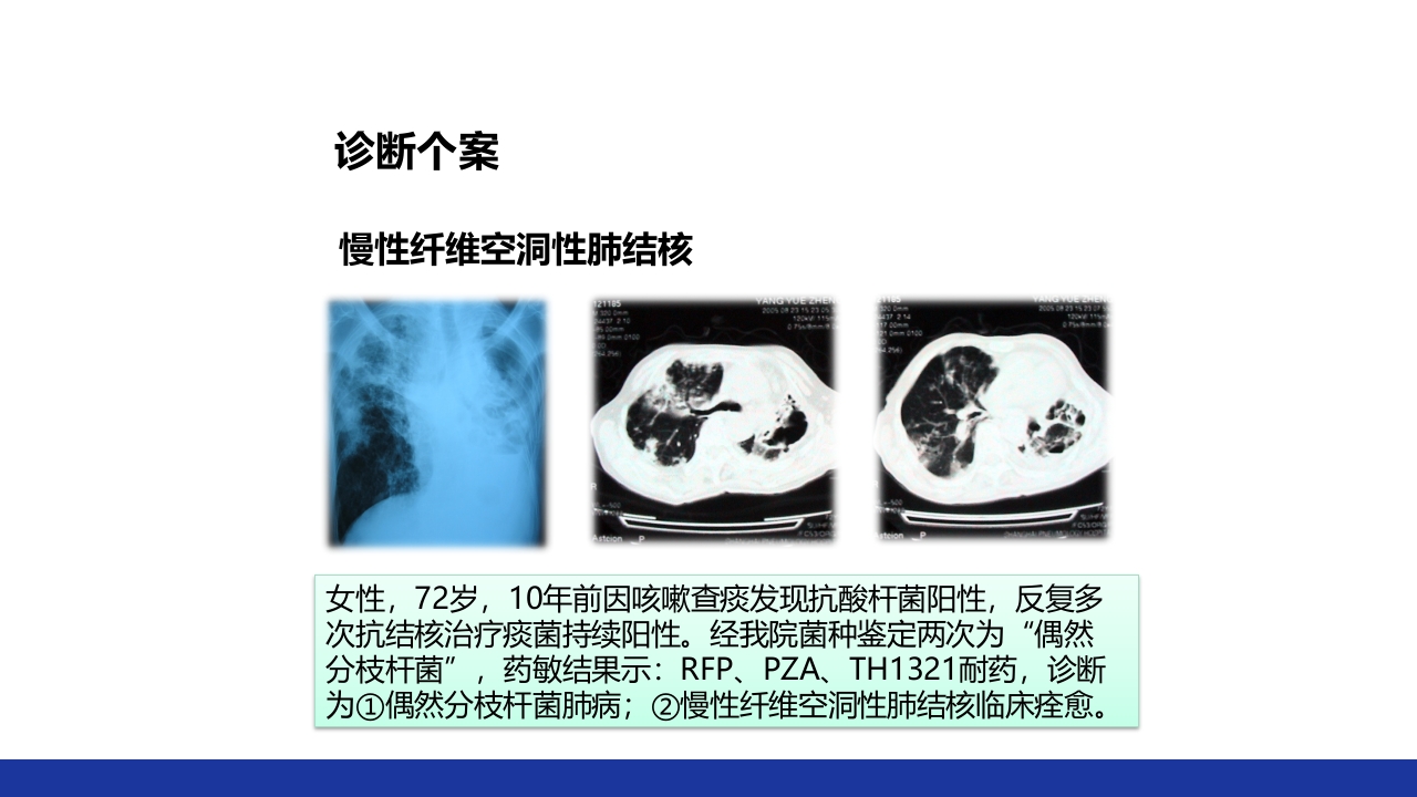 非结核分枝杆菌感染PPT课件37