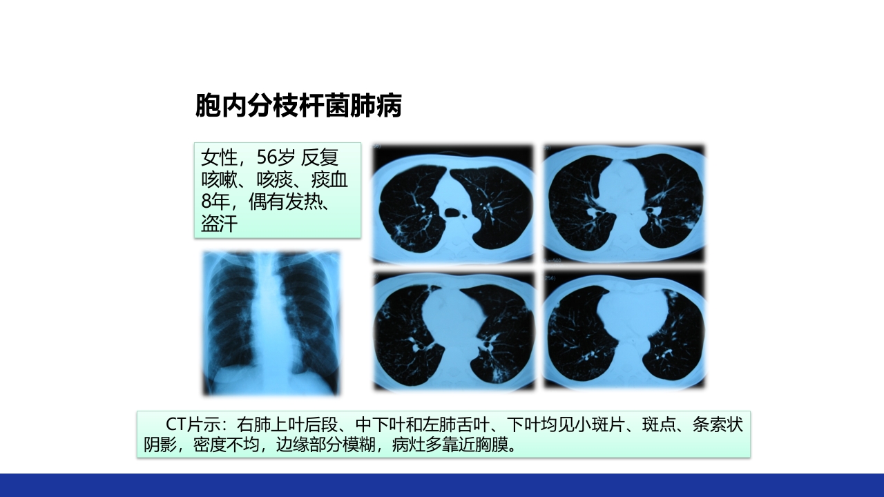 非结核分枝杆菌感染PPT课件38