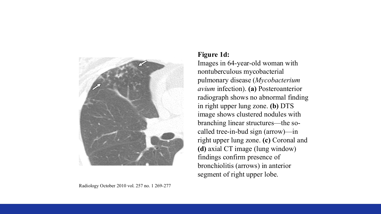 非结核分枝杆菌感染PPT课件39