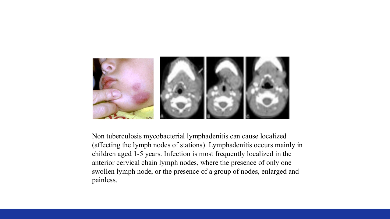 非结核分枝杆菌感染PPT课件40