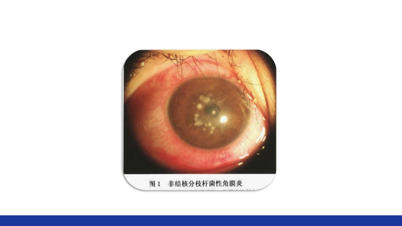 非结核分枝杆菌感染PPT课件42