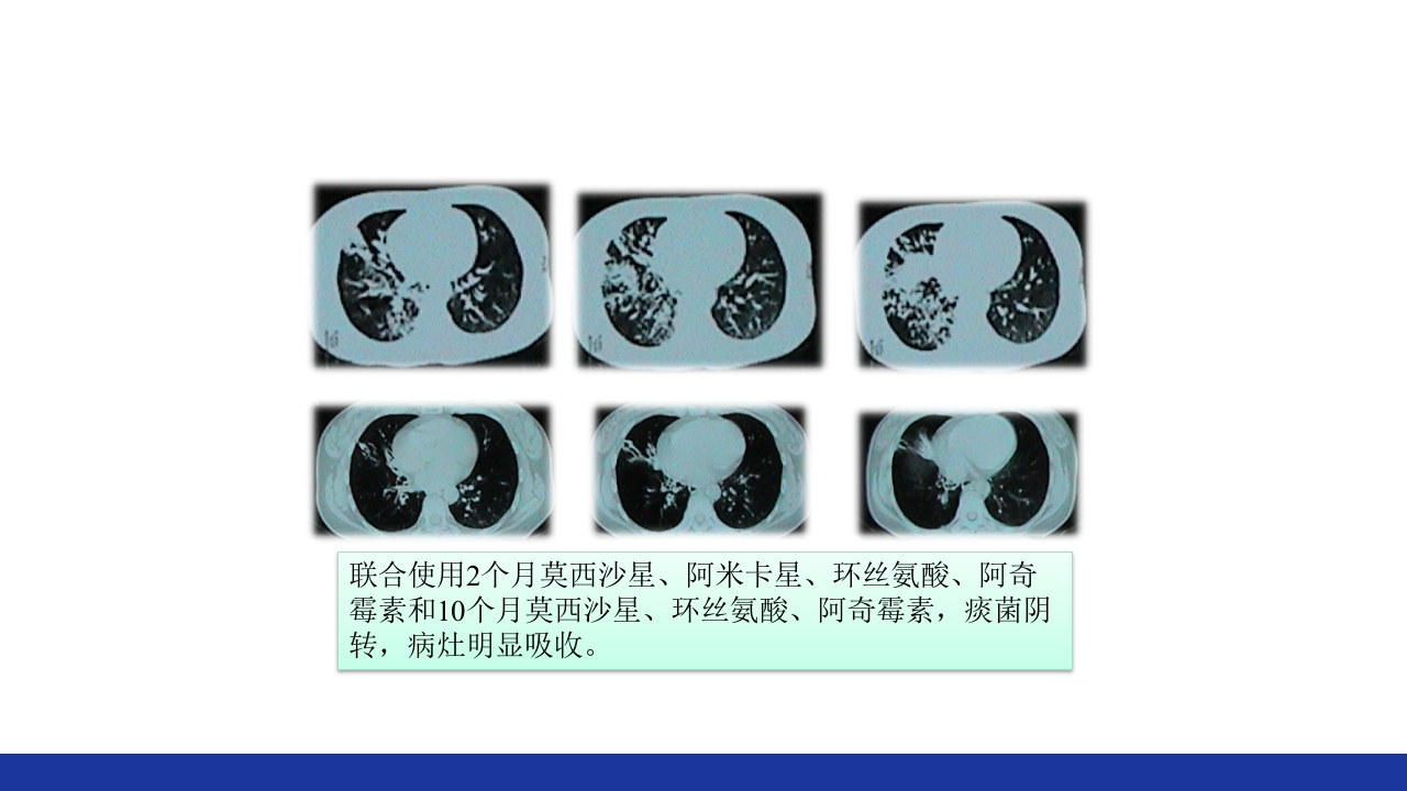 非结核分枝杆菌感染PPT课件57