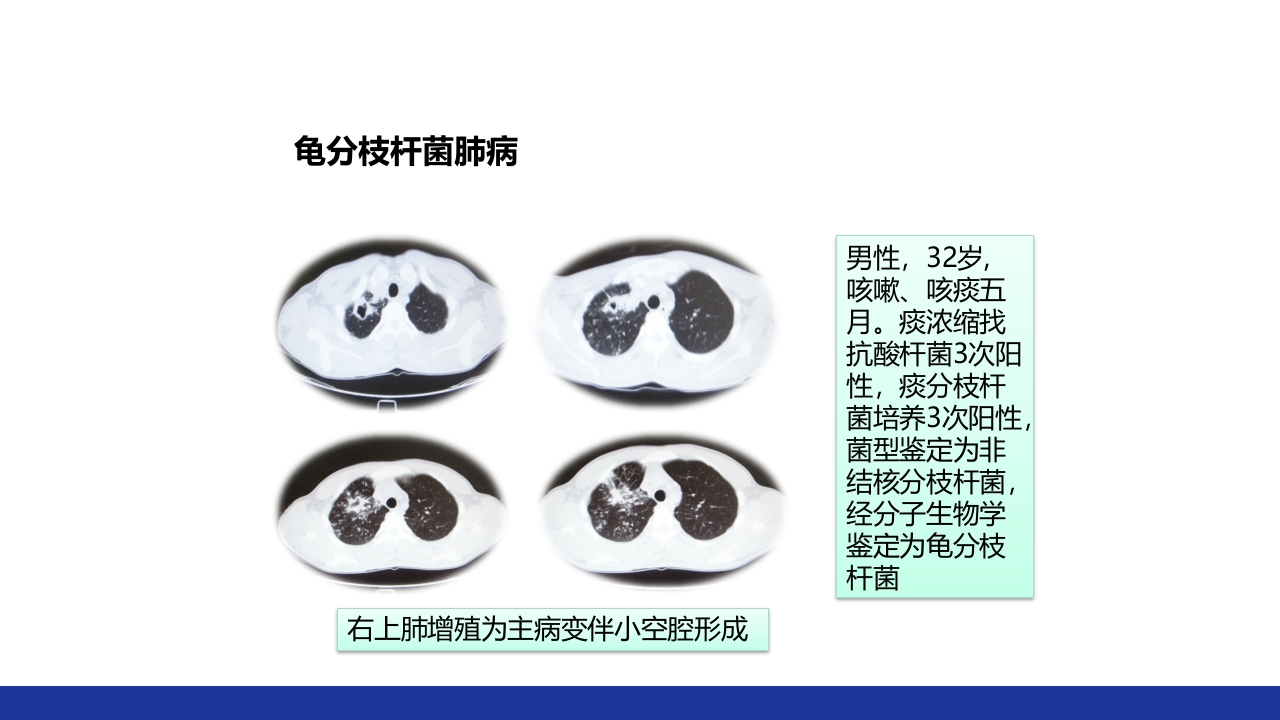 非结核分枝杆菌感染PPT课件58