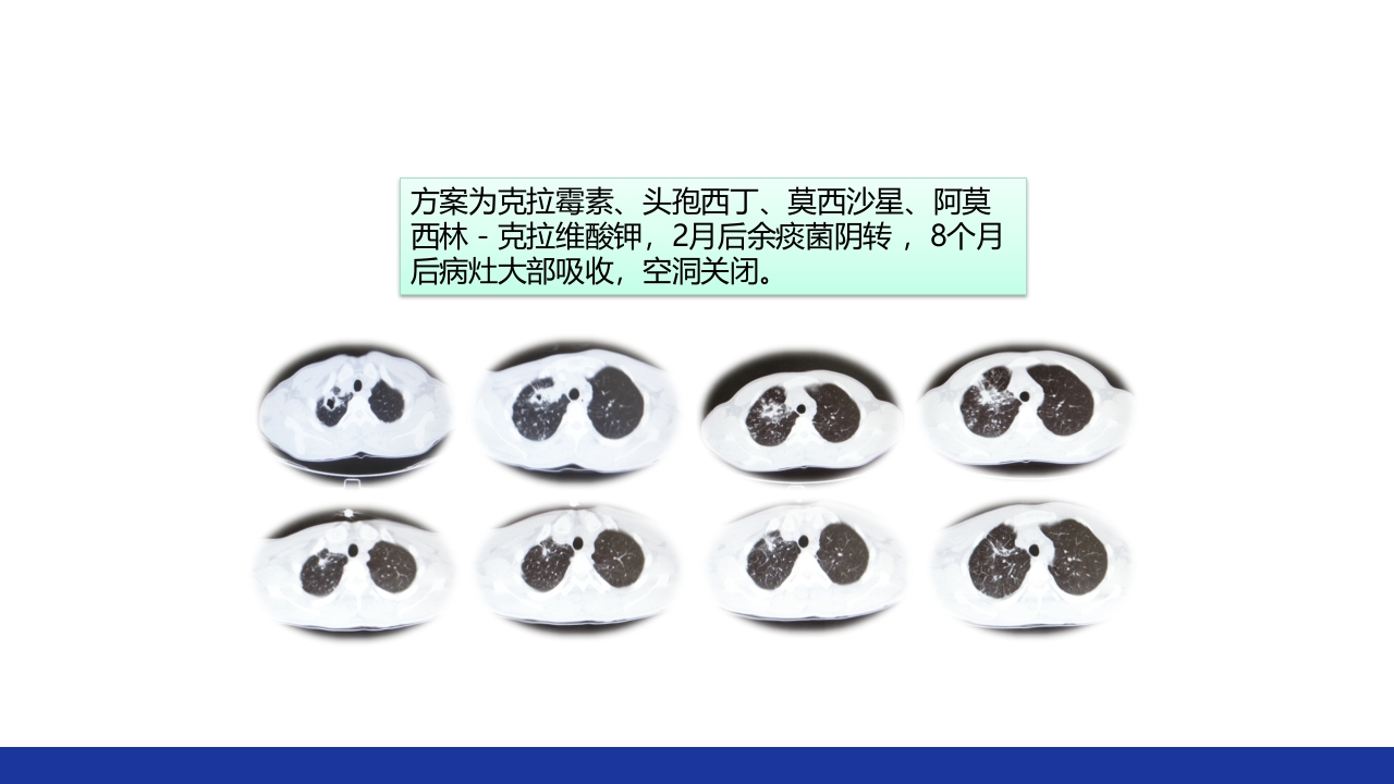 非结核分枝杆菌感染PPT课件59