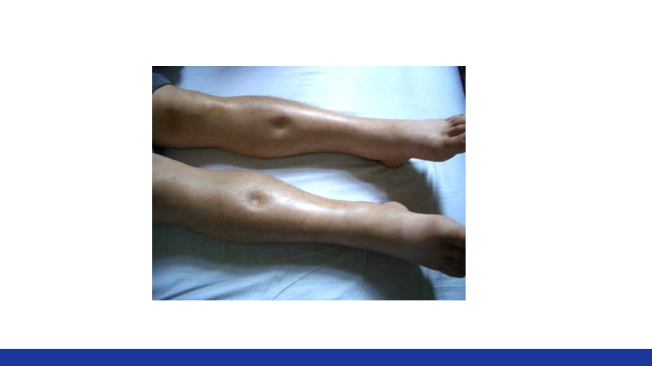 慢性肺源性心脏病PPT课件19