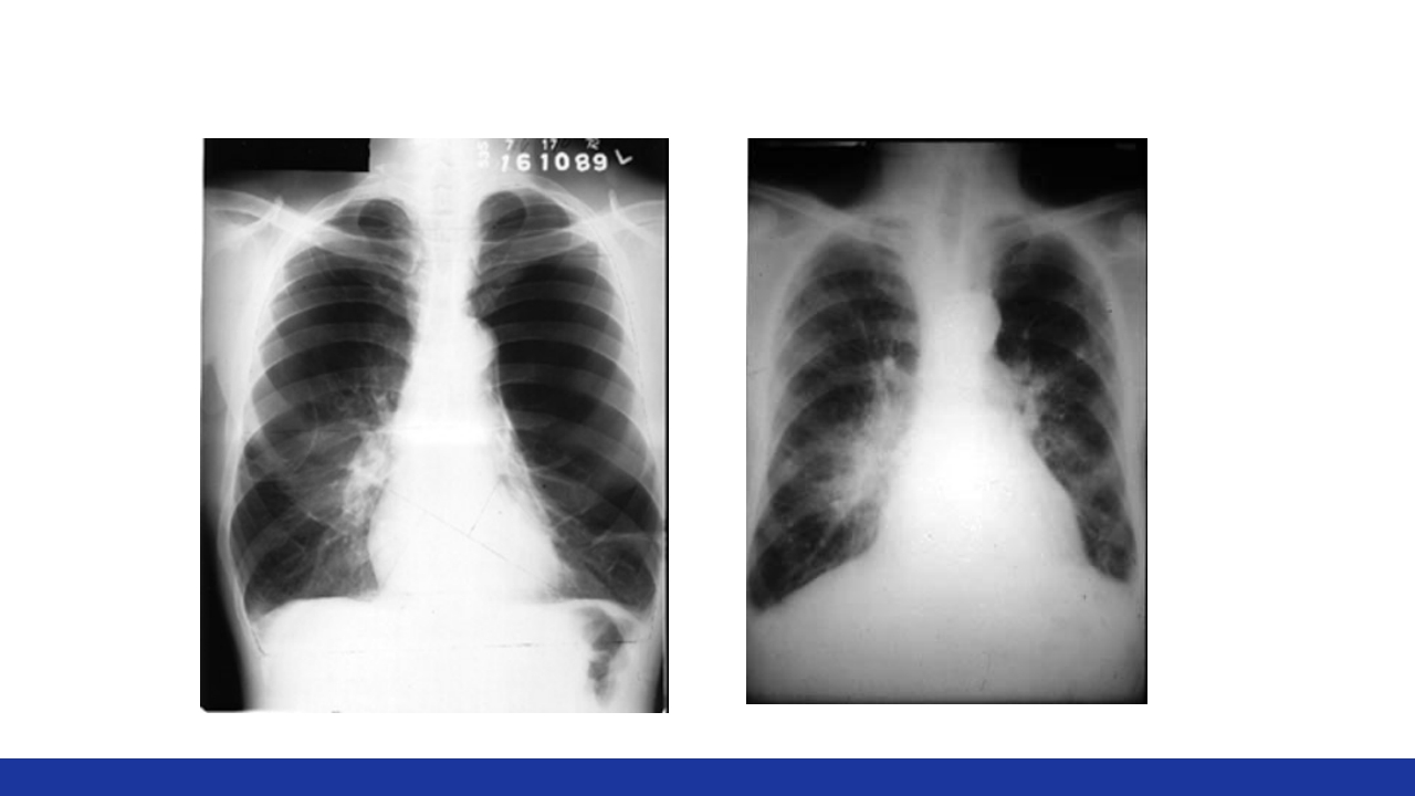 慢性肺源性心脏病PPT课件25