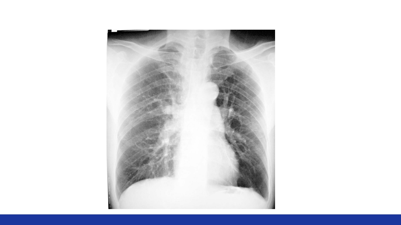 慢性肺源性心脏病PPT课件26