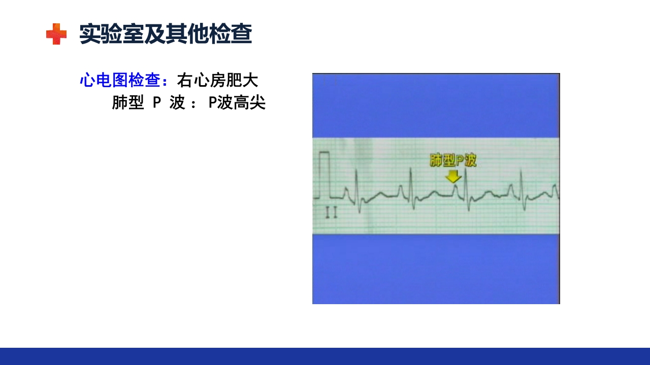 慢性肺源性心脏病PPT课件27