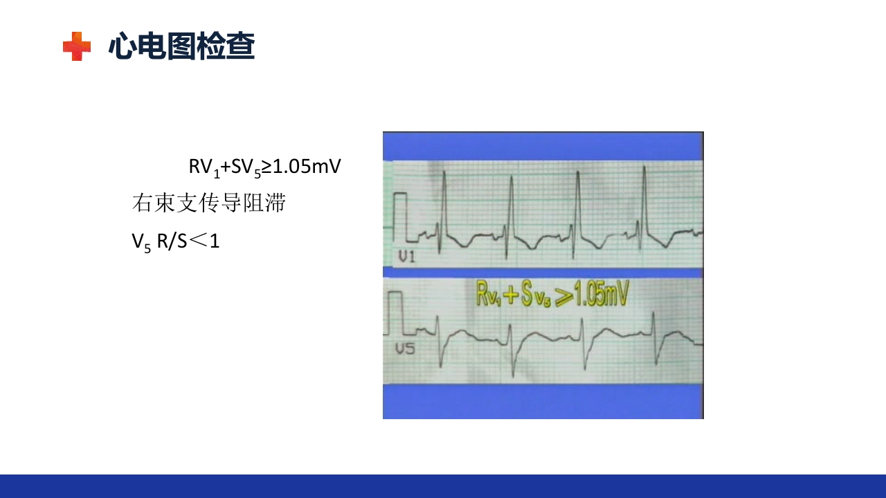慢性肺源性心脏病PPT课件29