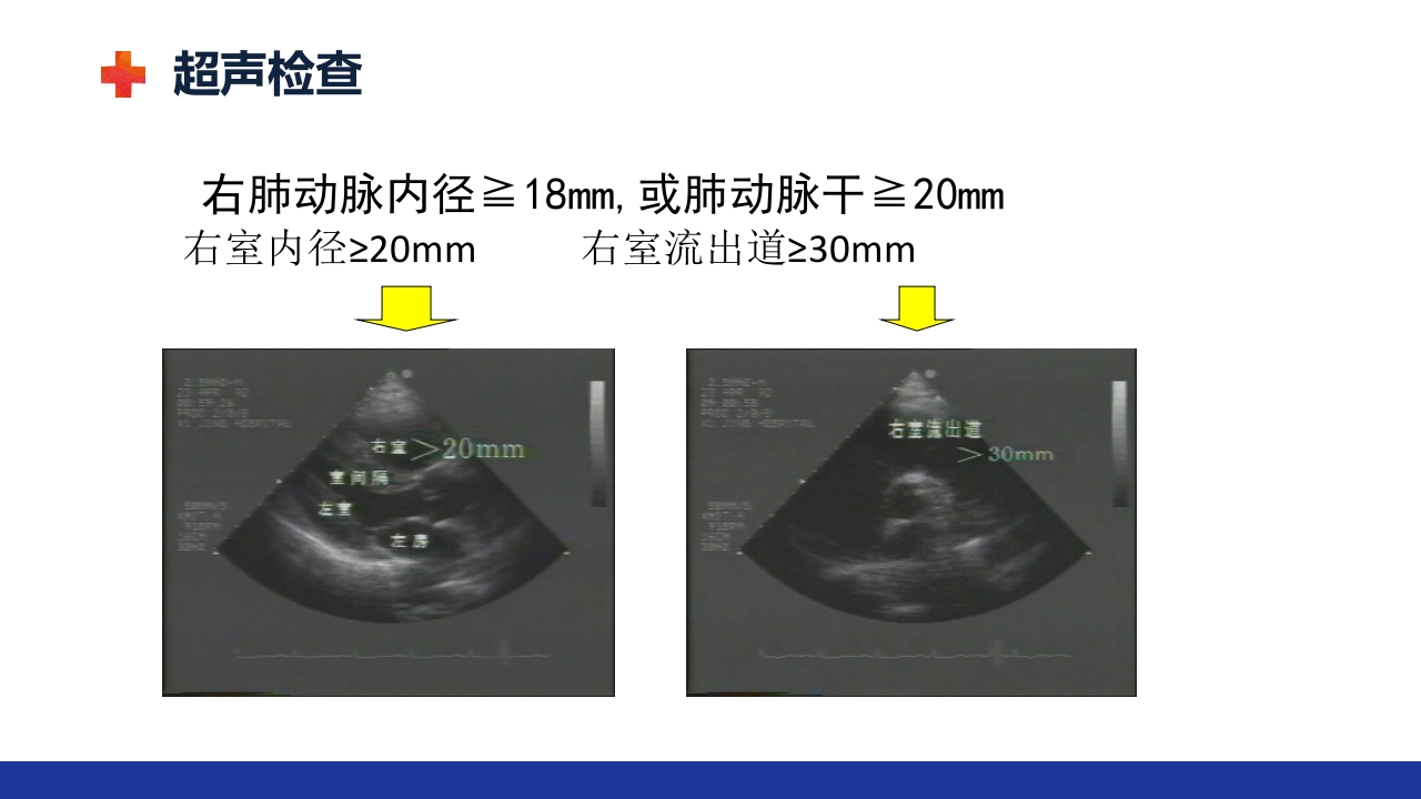 慢性肺源性心脏病PPT课件30