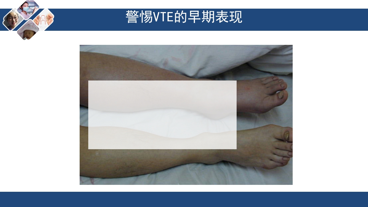 静脉血栓栓塞(VTE)诊断、治疗和预防ppt课件22