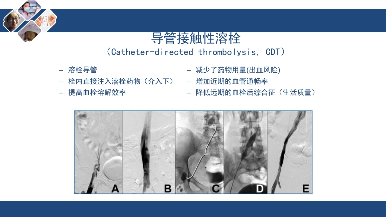 静脉血栓栓塞(VTE)诊断、治疗和预防ppt课件30