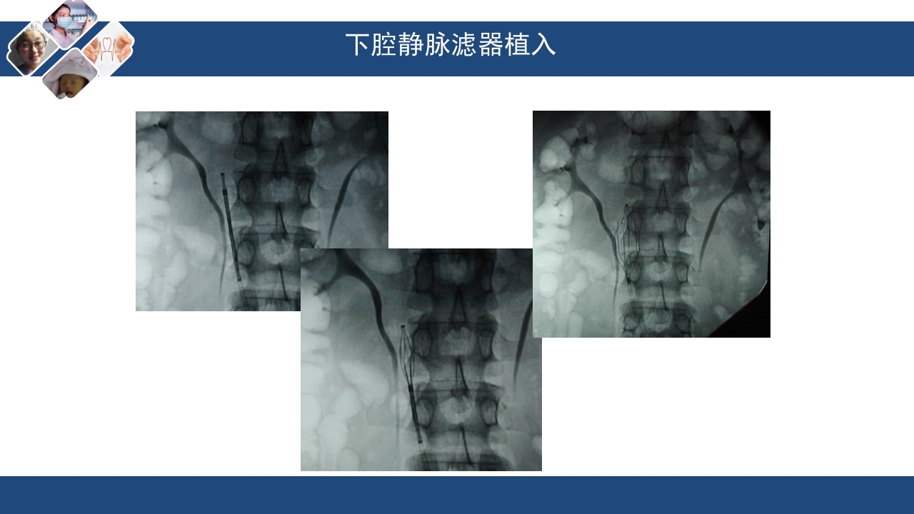 静脉血栓栓塞(VTE)诊断、治疗和预防ppt课件35