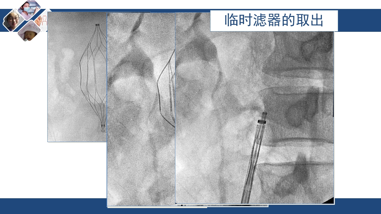 静脉血栓栓塞(VTE)诊断、治疗和预防ppt课件36