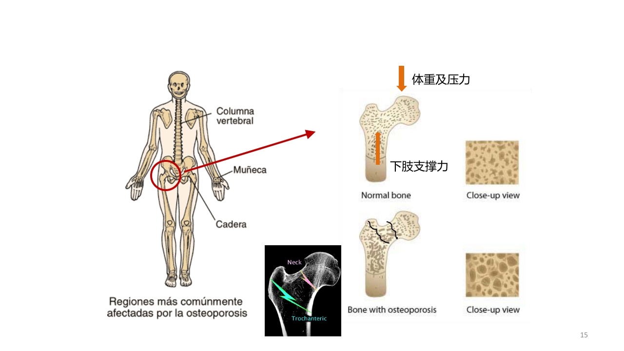骨质疏松的诊断与治疗ppt课件15