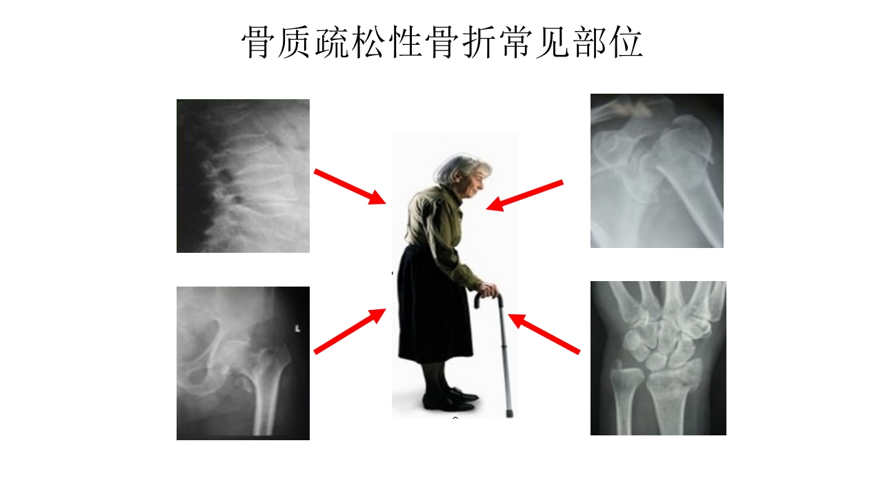 骨质疏松的诊断与治疗ppt课件16