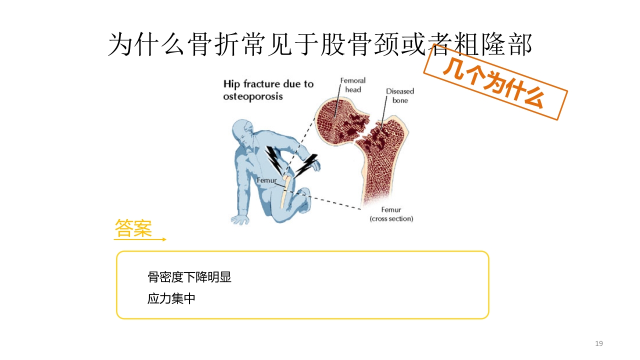 骨质疏松的诊断与治疗ppt课件19