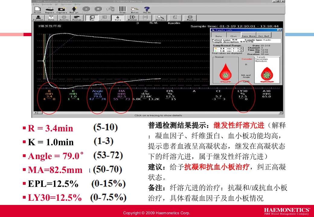血栓弹力图临床应用PPT课件23