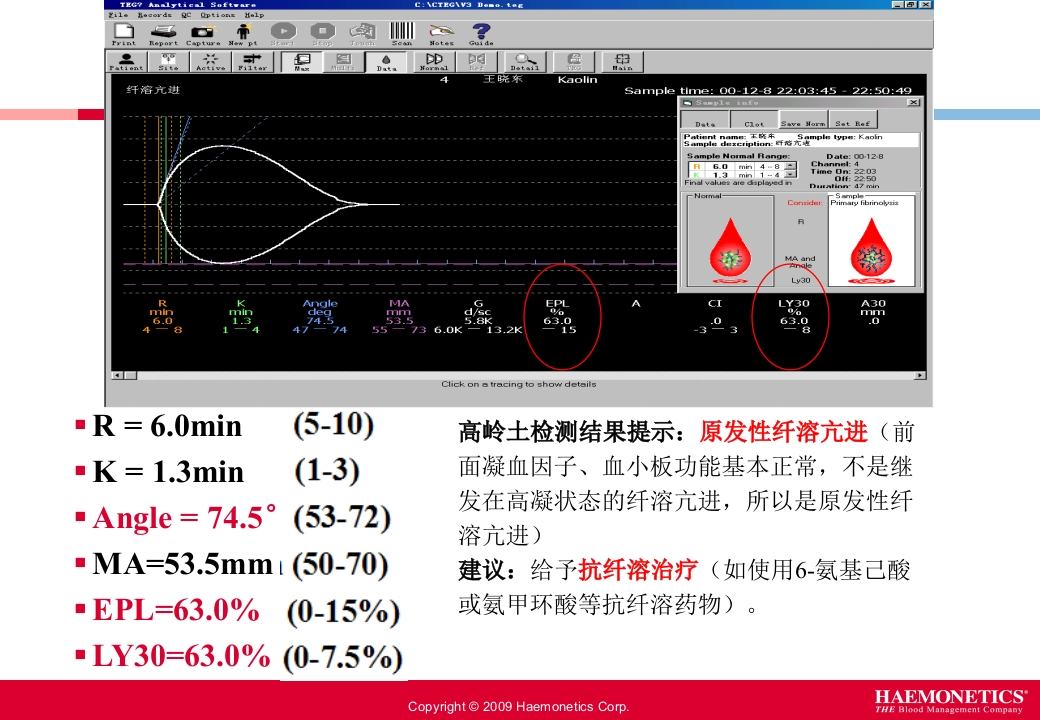 血栓弹力图临床应用PPT课件24