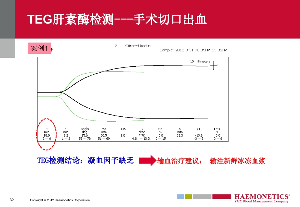 血栓弹力图临床应用PPT课件32