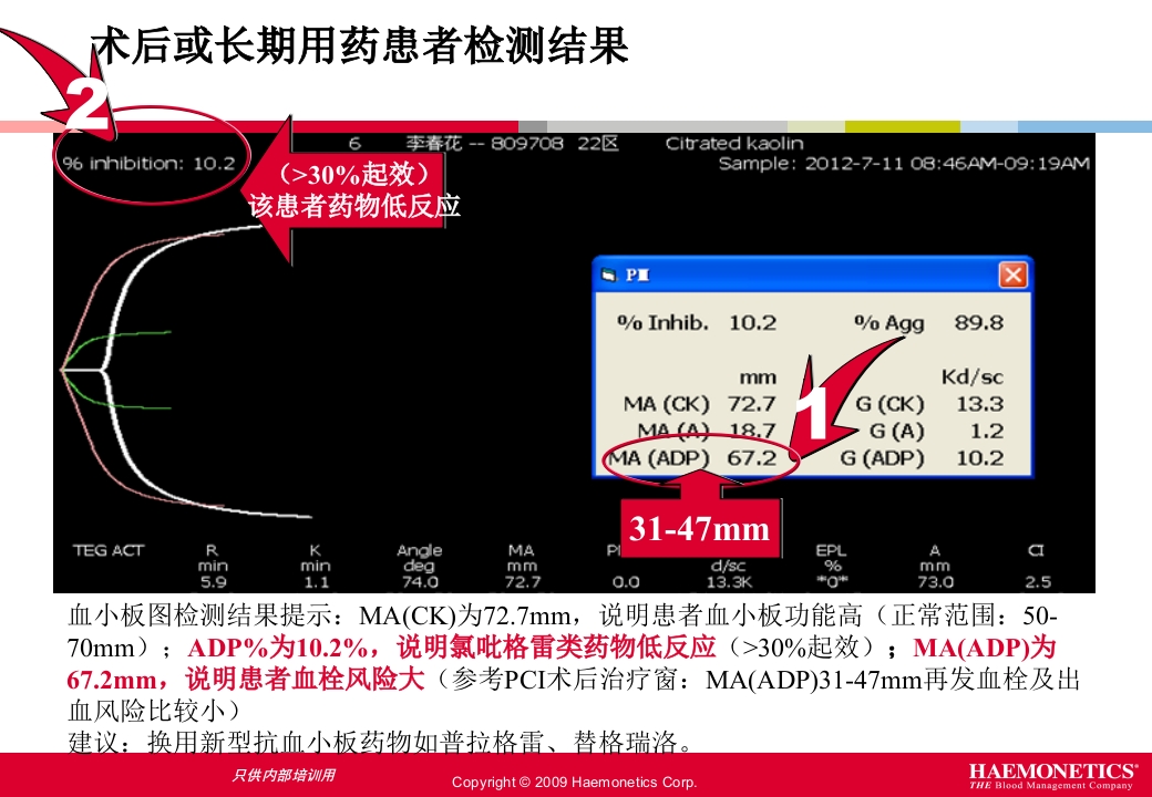 血栓弹力图临床应用PPT课件40