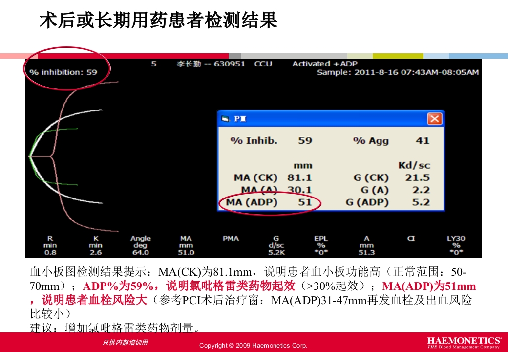 血栓弹力图临床应用PPT课件41
