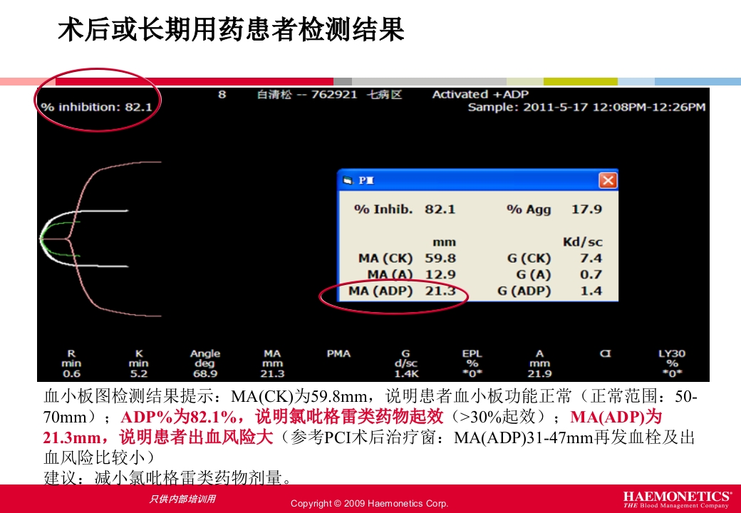 血栓弹力图临床应用PPT课件42