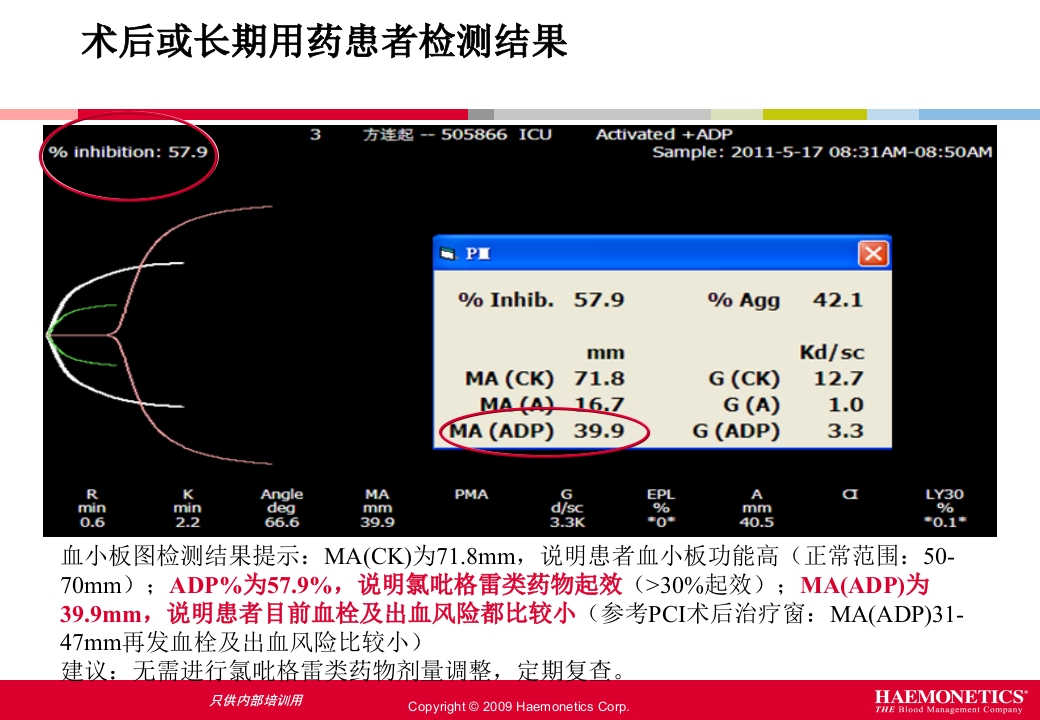 血栓弹力图临床应用PPT课件43