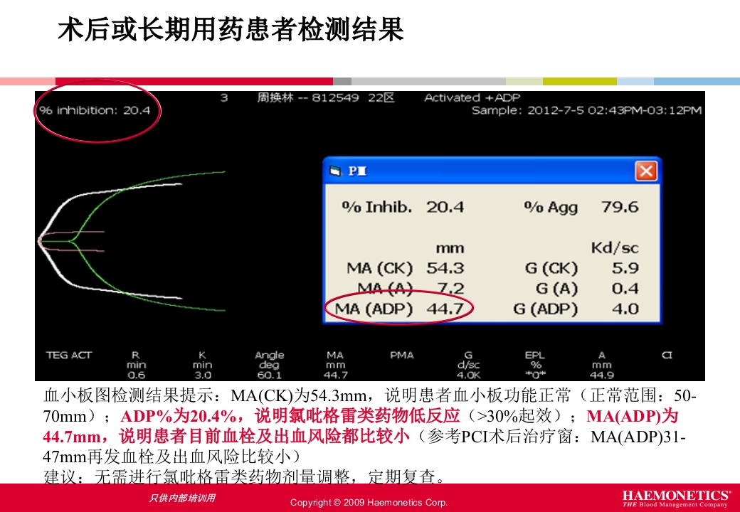 血栓弹力图临床应用PPT课件44