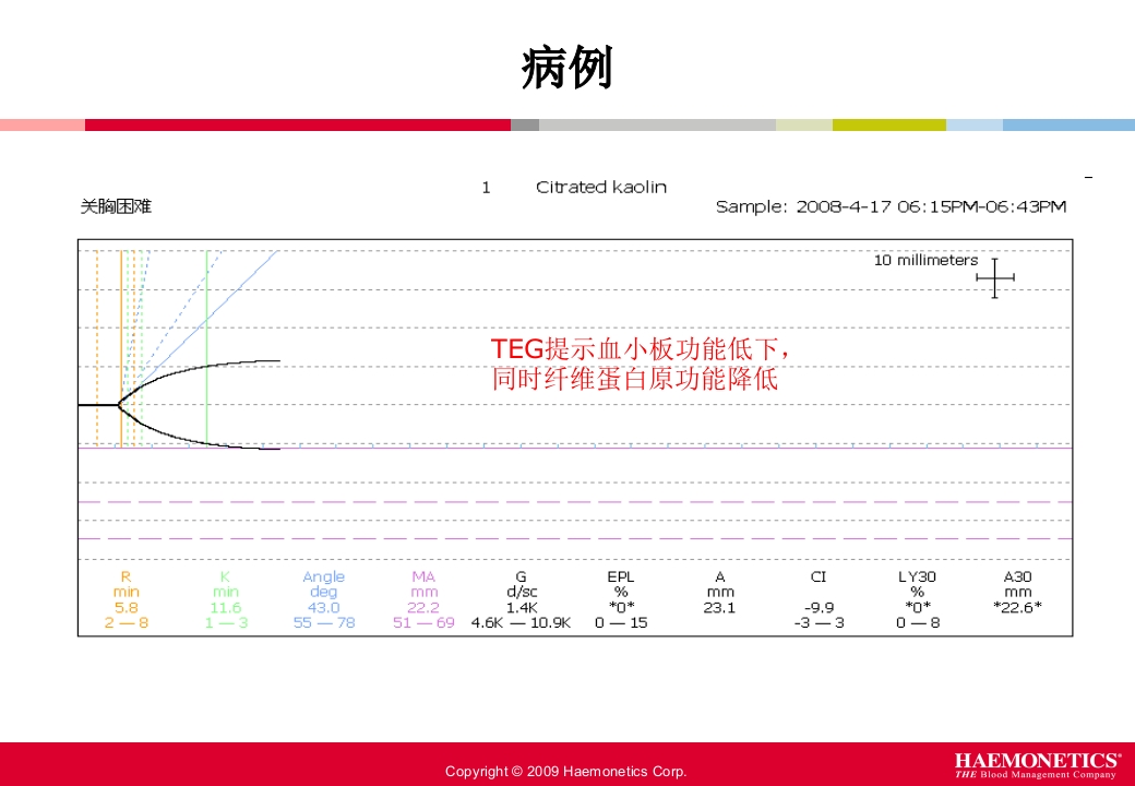 血栓弹力图临床应用PPT课件58