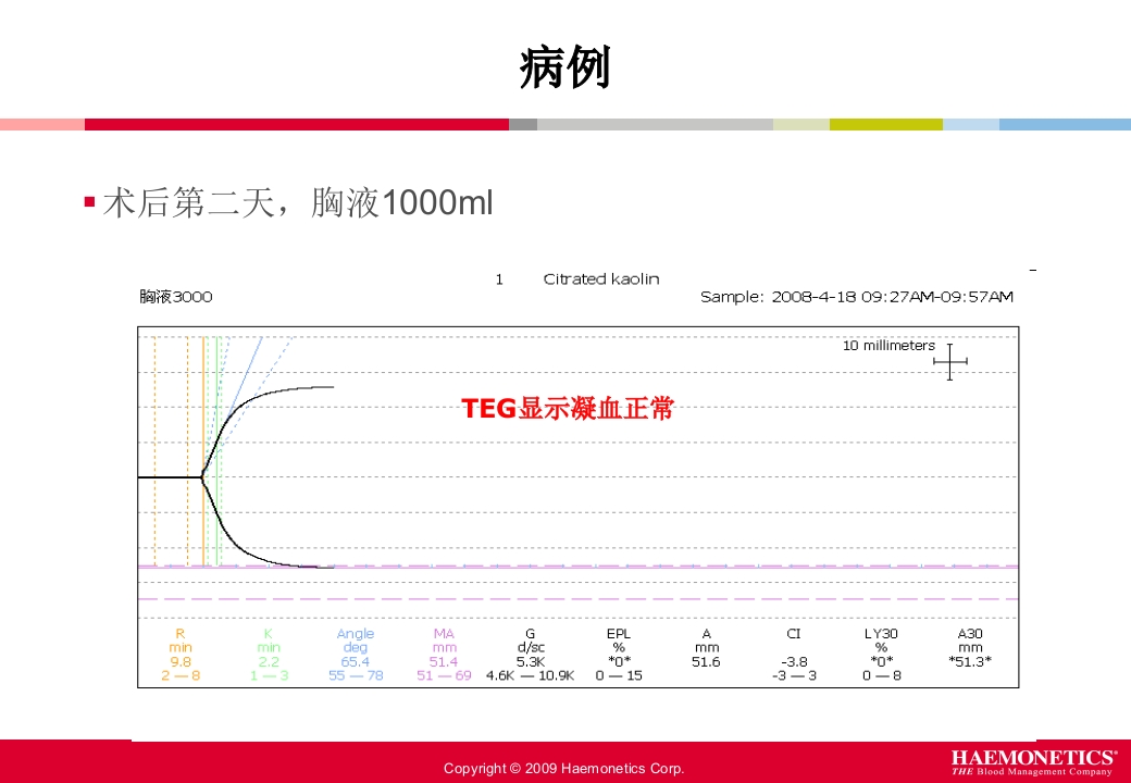 血栓弹力图临床应用PPT课件61