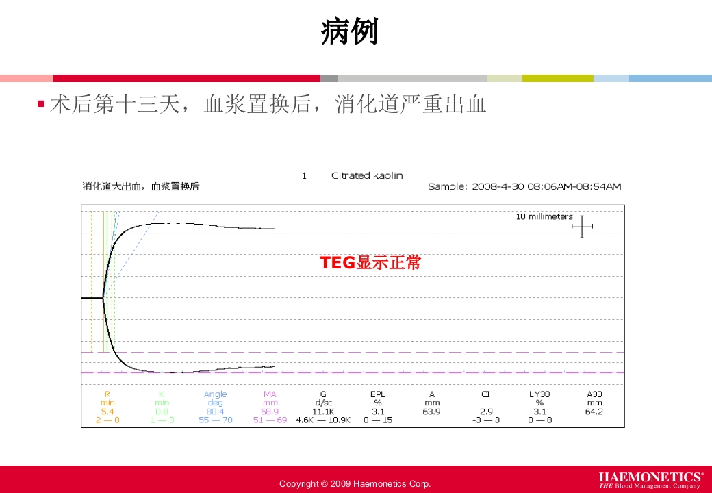 血栓弹力图临床应用PPT课件67