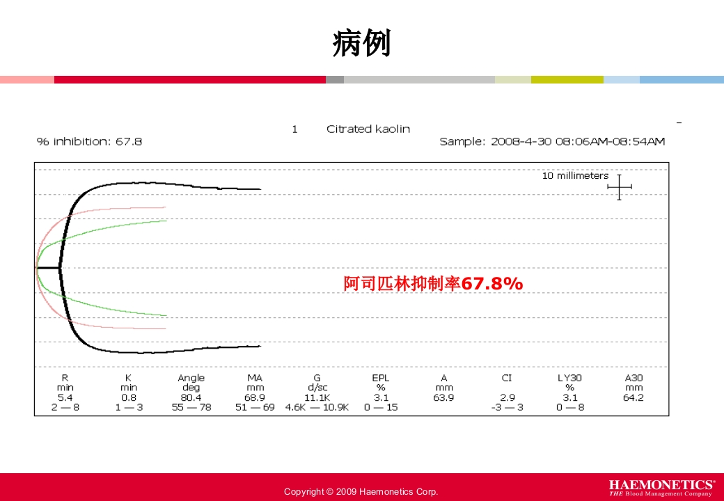 血栓弹力图临床应用PPT课件68