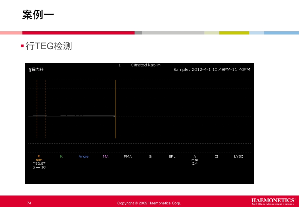 血栓弹力图临床应用PPT课件74