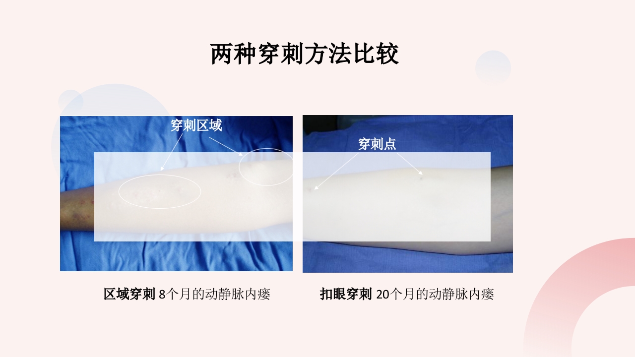 钝针穿刺法临床应用护理PPT课件11