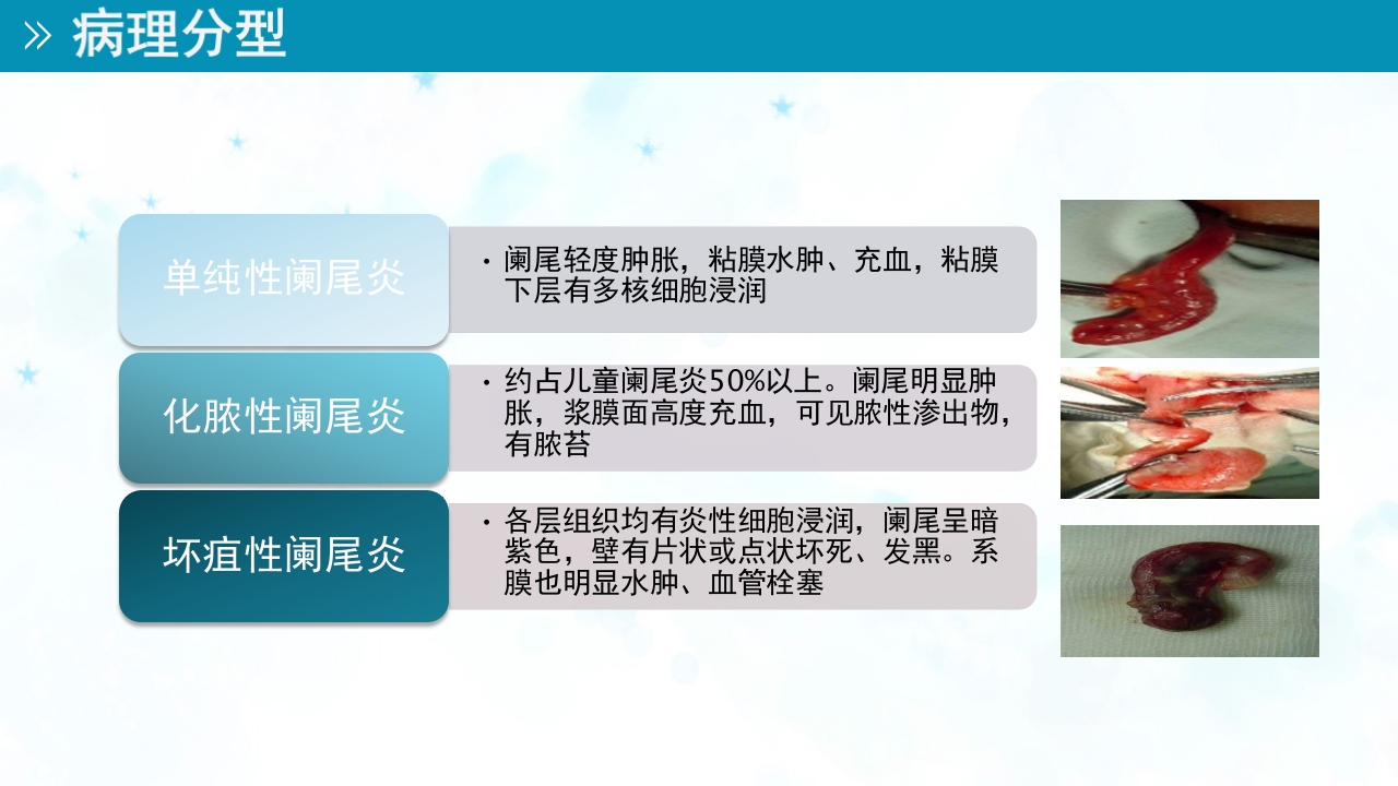 小儿急性阑尾炎的护理ppt课件4