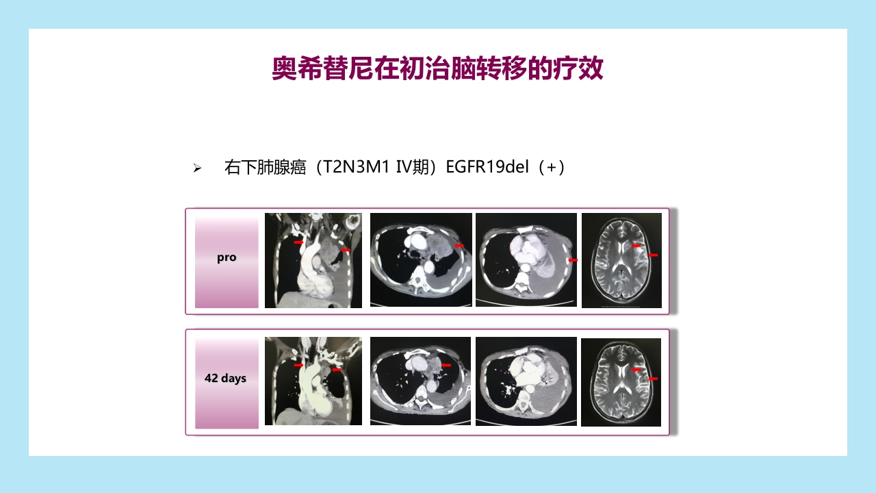 精准之路：EGFR突变NSCLC患者靶向治疗全程管理PPT课件25