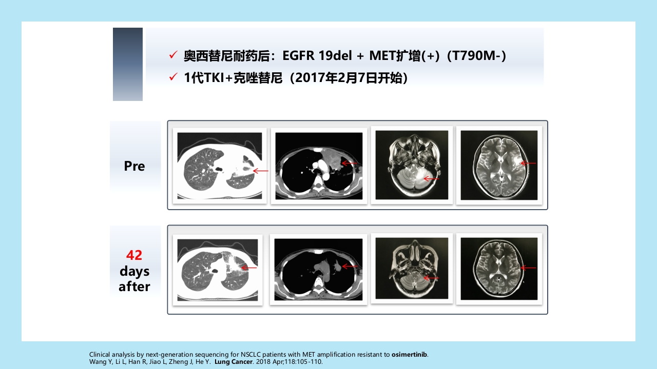 精准之路：EGFR突变NSCLC患者靶向治疗全程管理PPT课件39