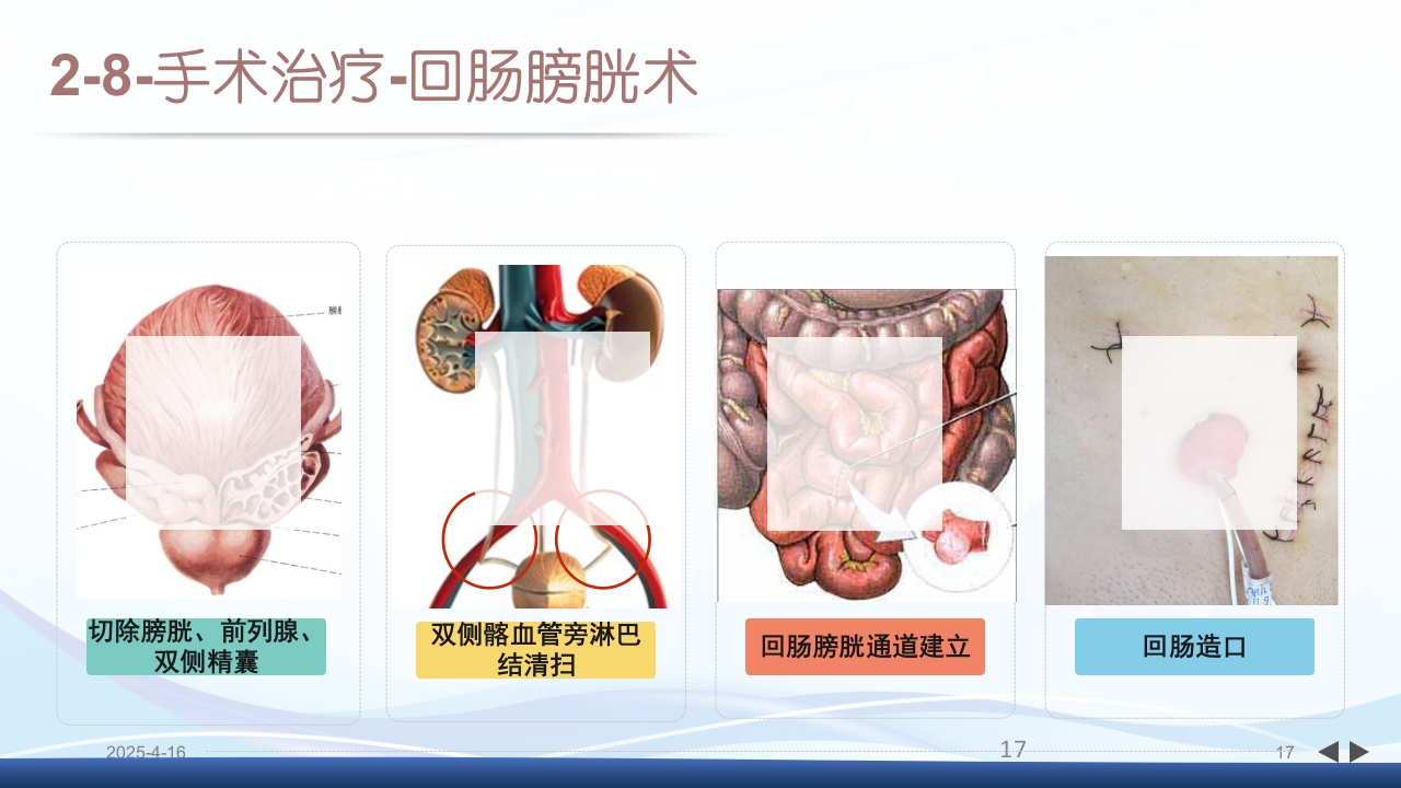 膀胱全切+回肠膀胱造口围手术期的护理查房PPT课件17
