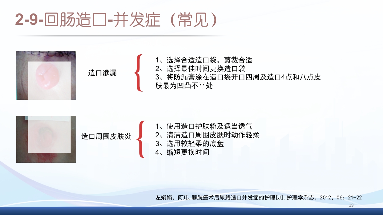膀胱全切+回肠膀胱造口围手术期的护理查房PPT课件19