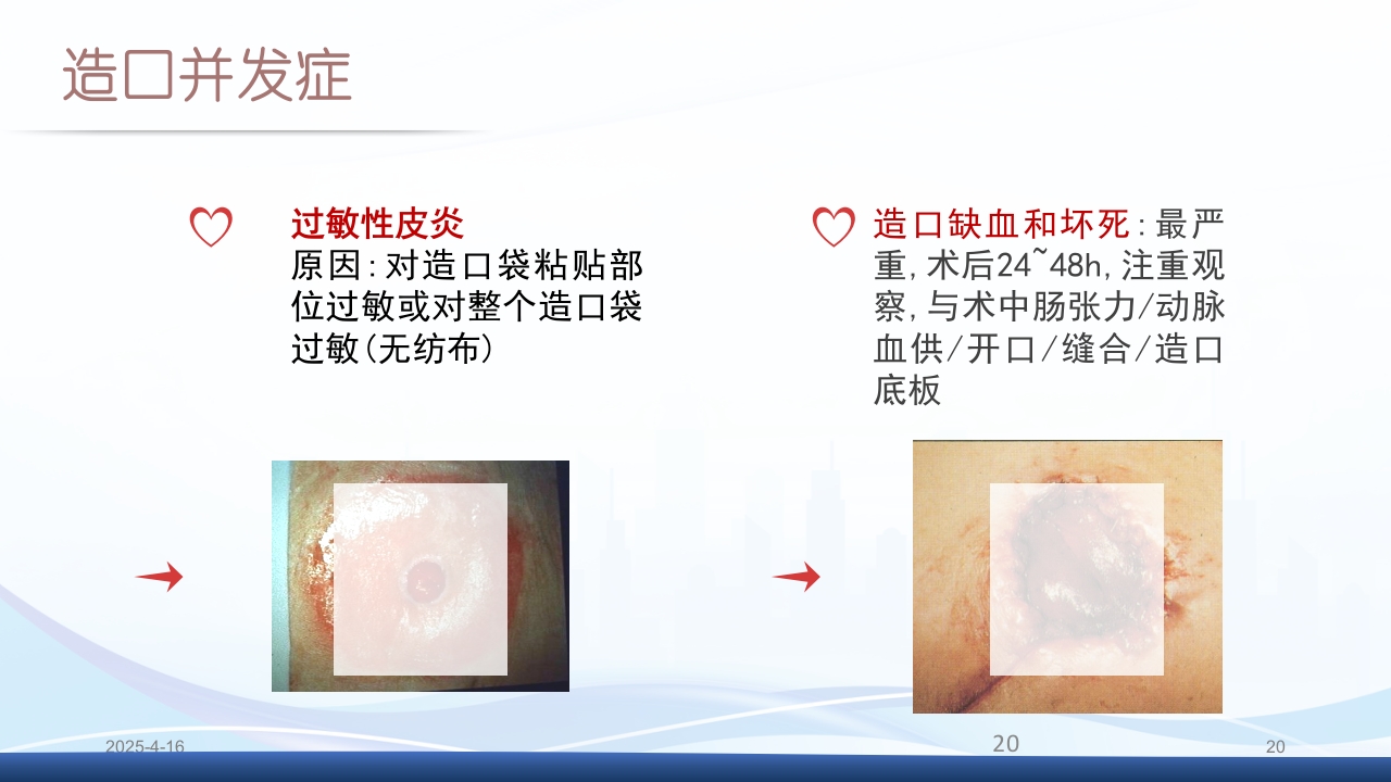 膀胱全切+回肠膀胱造口围手术期的护理查房PPT课件20